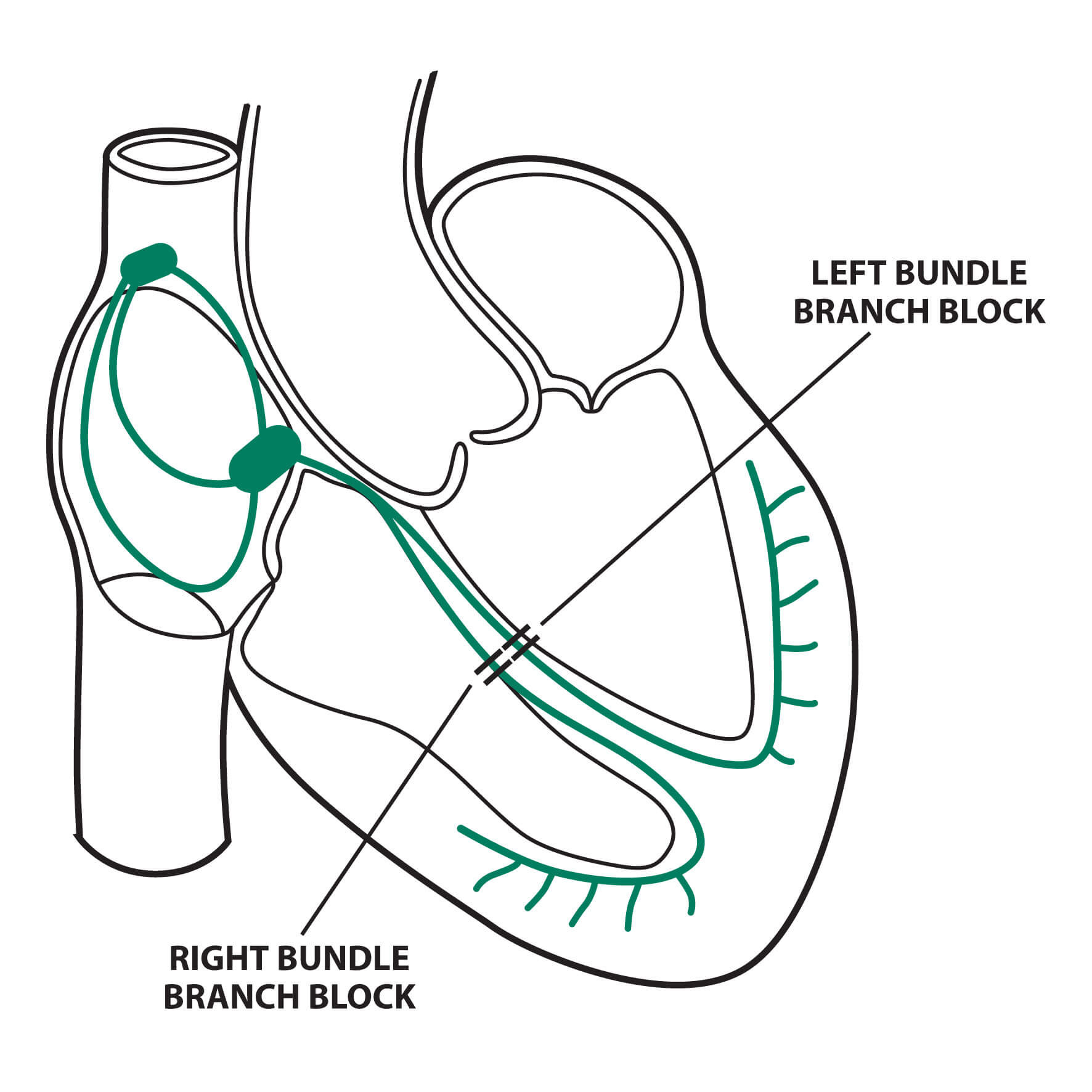 Bundle Branch Block
