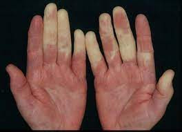 Penyakit Raynaud