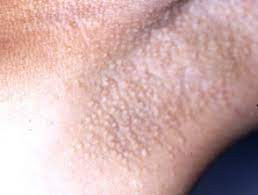Miliaria Apokrin (Penyakit Fox-Fordyce)