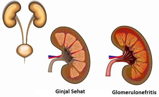 Glomerulonefritis Akut