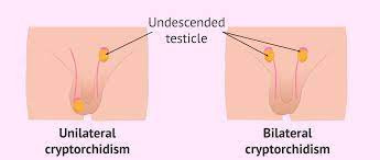 Undescending Testis
