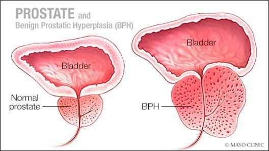Hiperplasia Prostat Jinak (BPH)