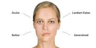 Miastenia Gravis