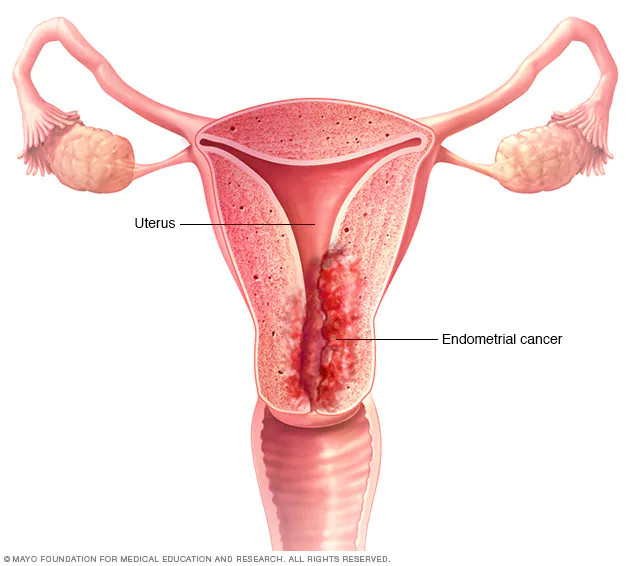 Karsinoma Endometrium