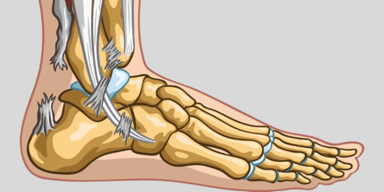 Ruptur Tendon Achilles