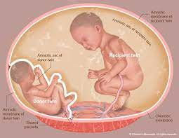 Twin-to-twin Transfusion Syndrome (TTTS)