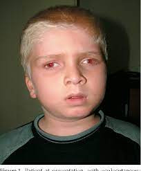 Sindrom Hermansky-Pudlak