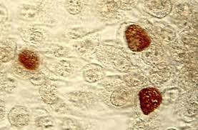 Limfogranuloma Vereneum