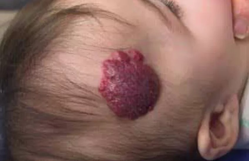 Hemangioma Kavernosa