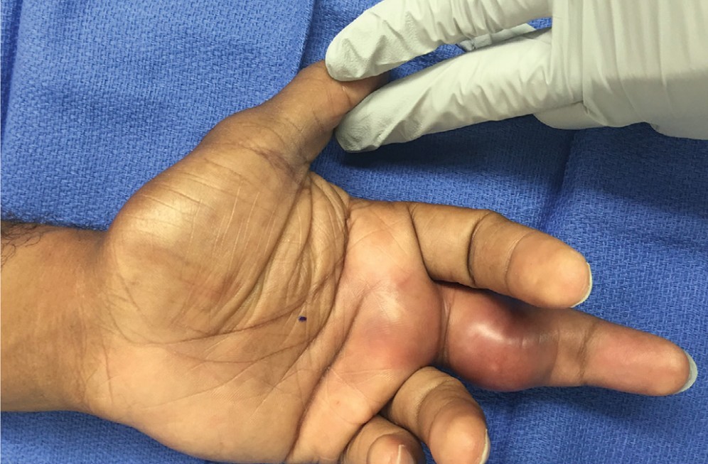 Tenosinovitis Supuratif