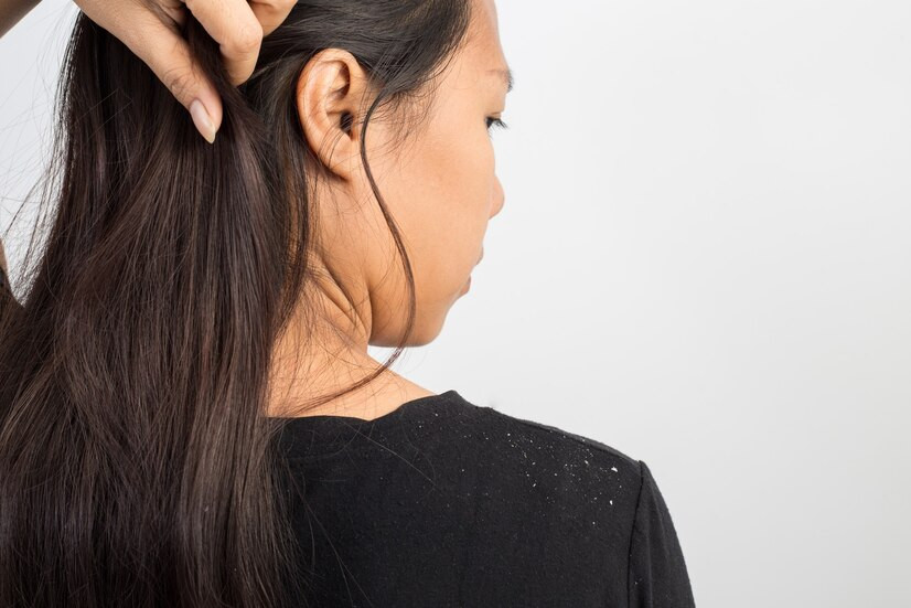 Ini Bedanya Ketombe Kering dan Ketombe Basah