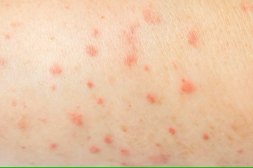 Mirip Seperti Memar, Apakah Sebenarnya Purpura?