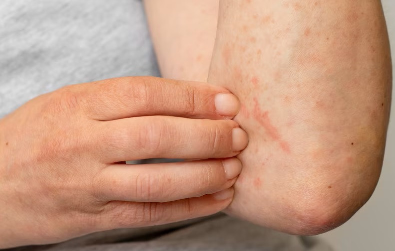 Perbedaan Antara Eksim dan Psoriasis
