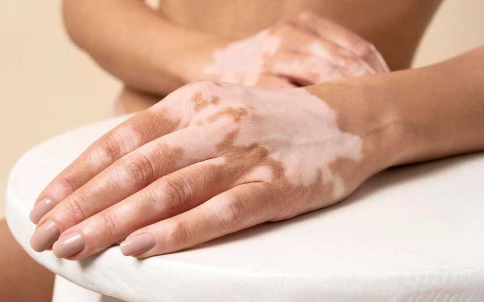 Mengenal Jenis-Jenis Vitiligo
