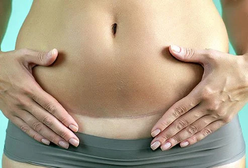 Lima Tips Pemulihan Operasi Caesar yang Penting Diketahui